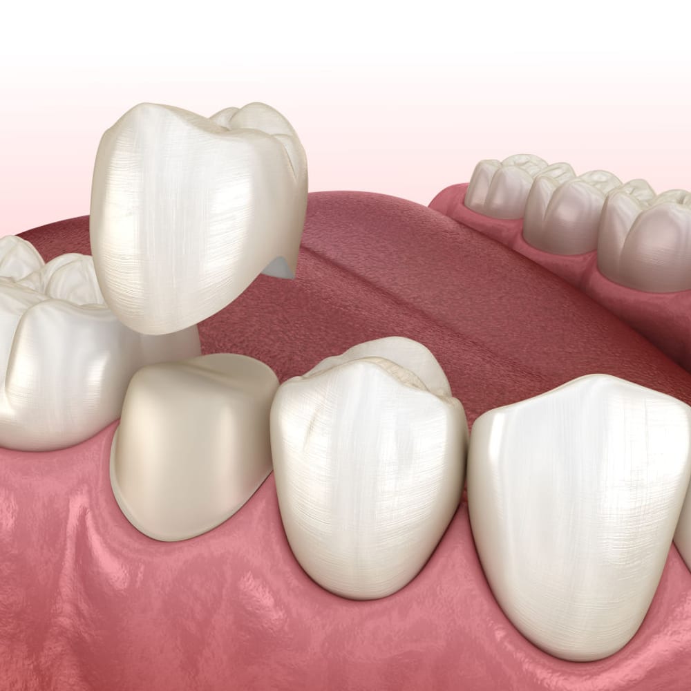 Milled crown being seated during restorative treatment