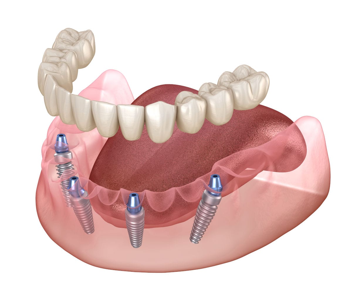 All-on-4 dental implants supporting a full arch prosthesis