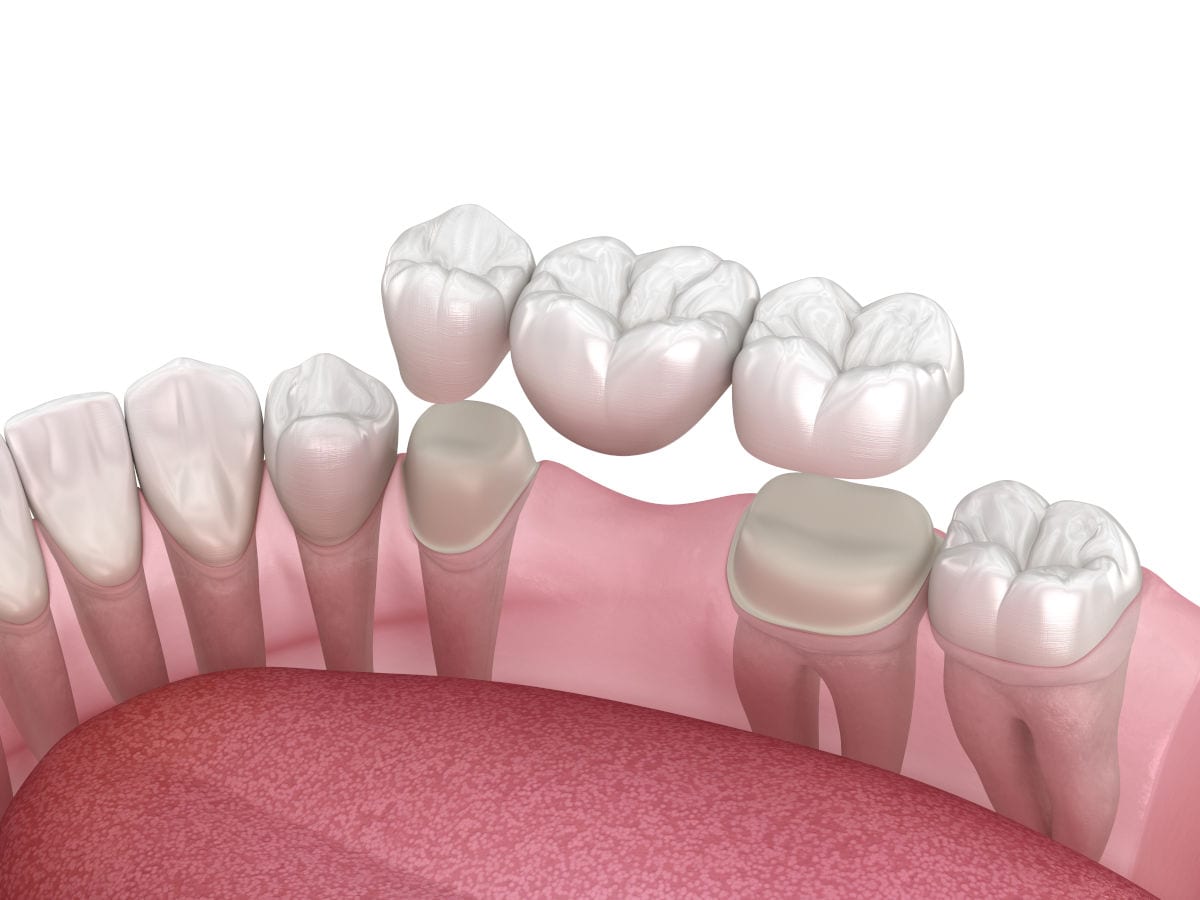 Dental bridge and dental implant side by side comparison