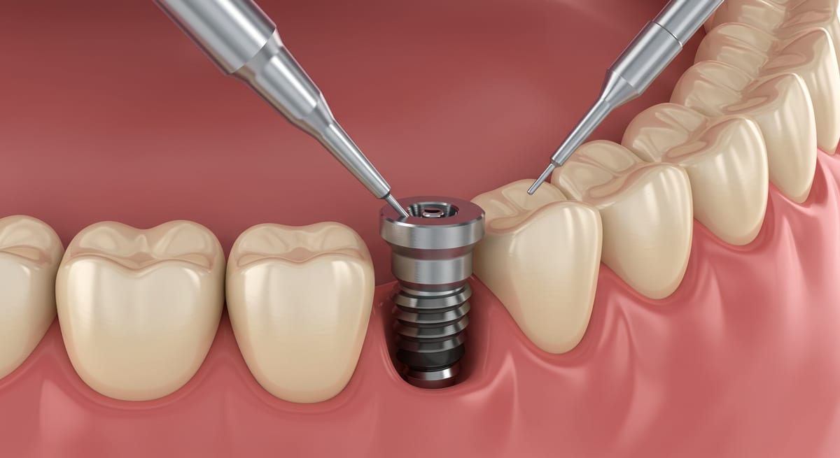 Dental implant treatment in Surrey, BC