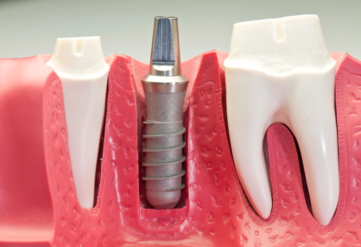 Dental implants in Metro Vancouver: options and costs