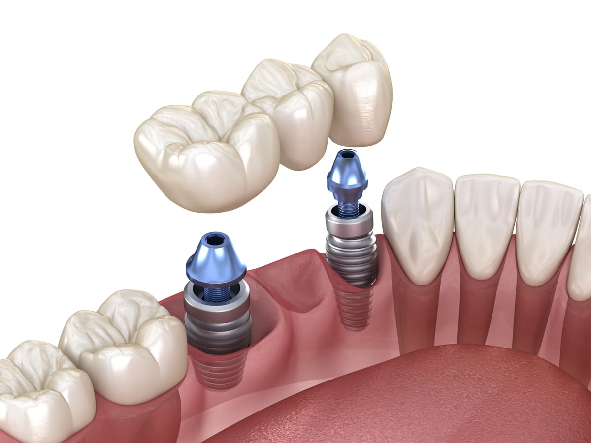 Screwless dental implant crown and abutment connection