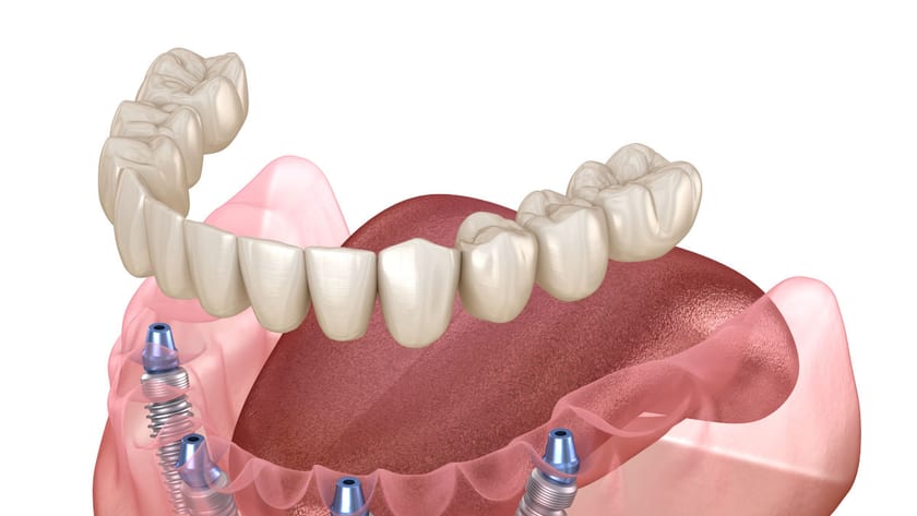 Full arch prosthesis supported by four dental implants
