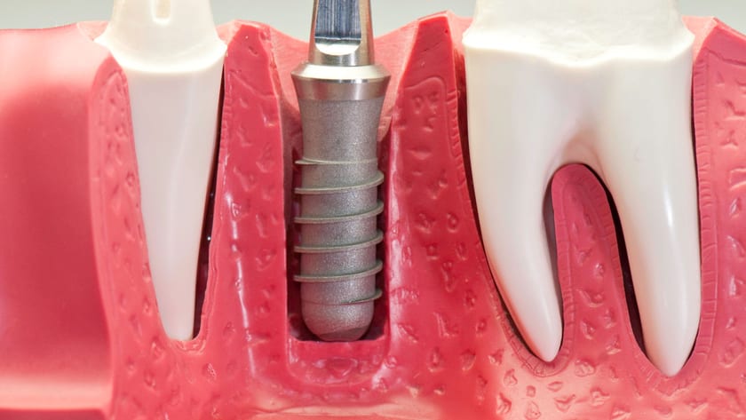 Cross section of a dental implant anchored in jawbone