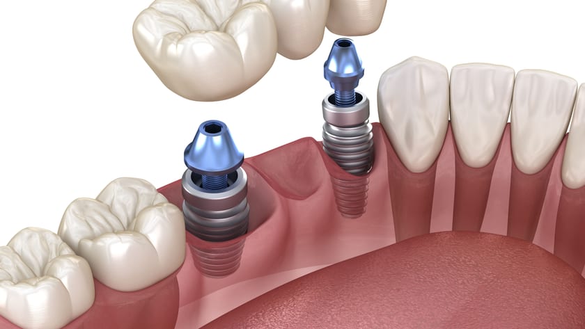 Dental bridge anchored on two implant abutments
