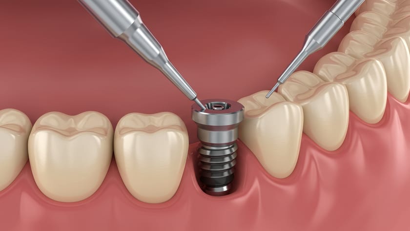 Single tooth dental implant being placed between two natural teeth